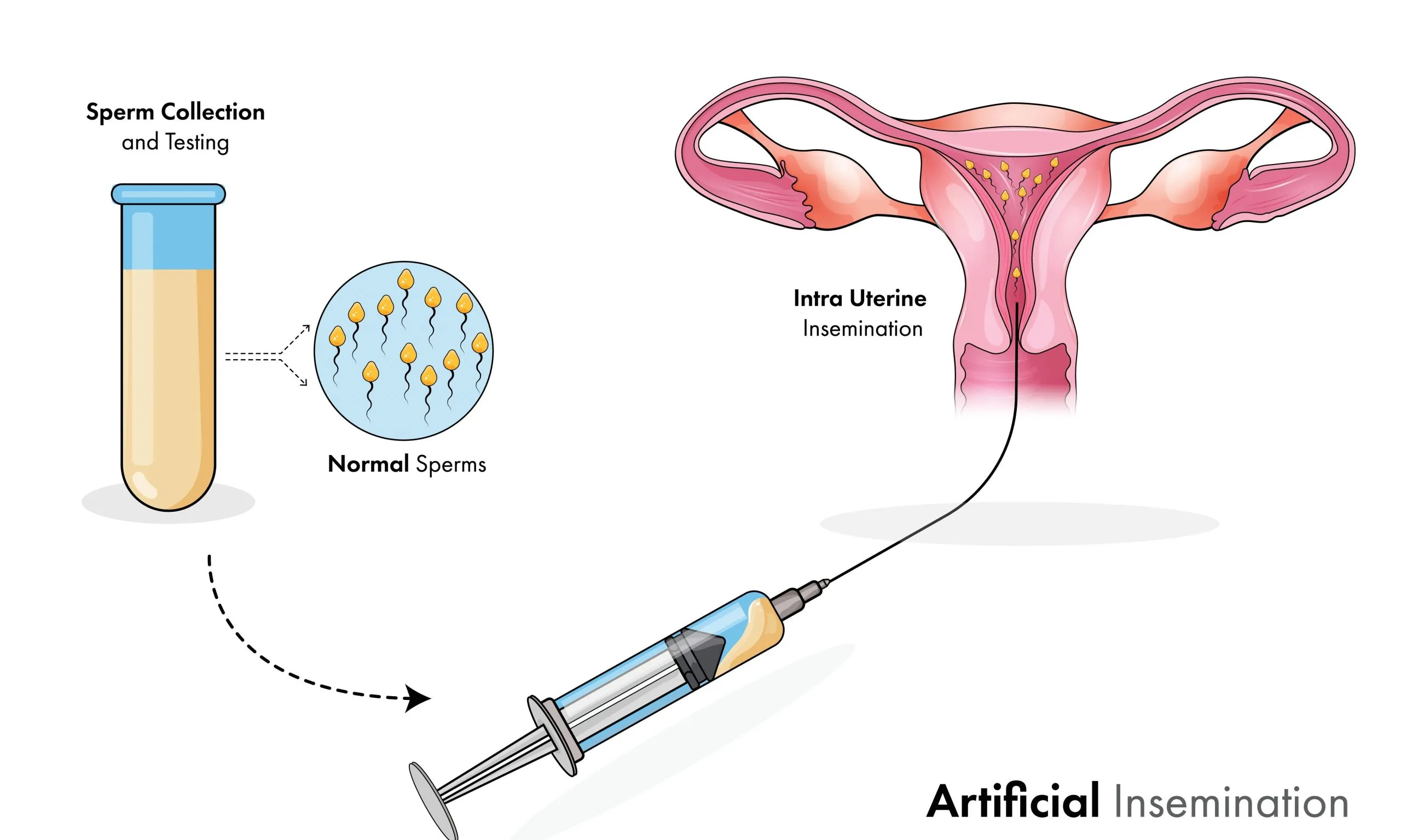 Insemination in Istanbul in der Türkei