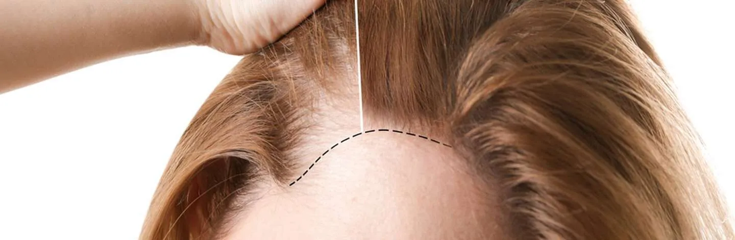 Hair transplant for women in Istanbul in Turkey