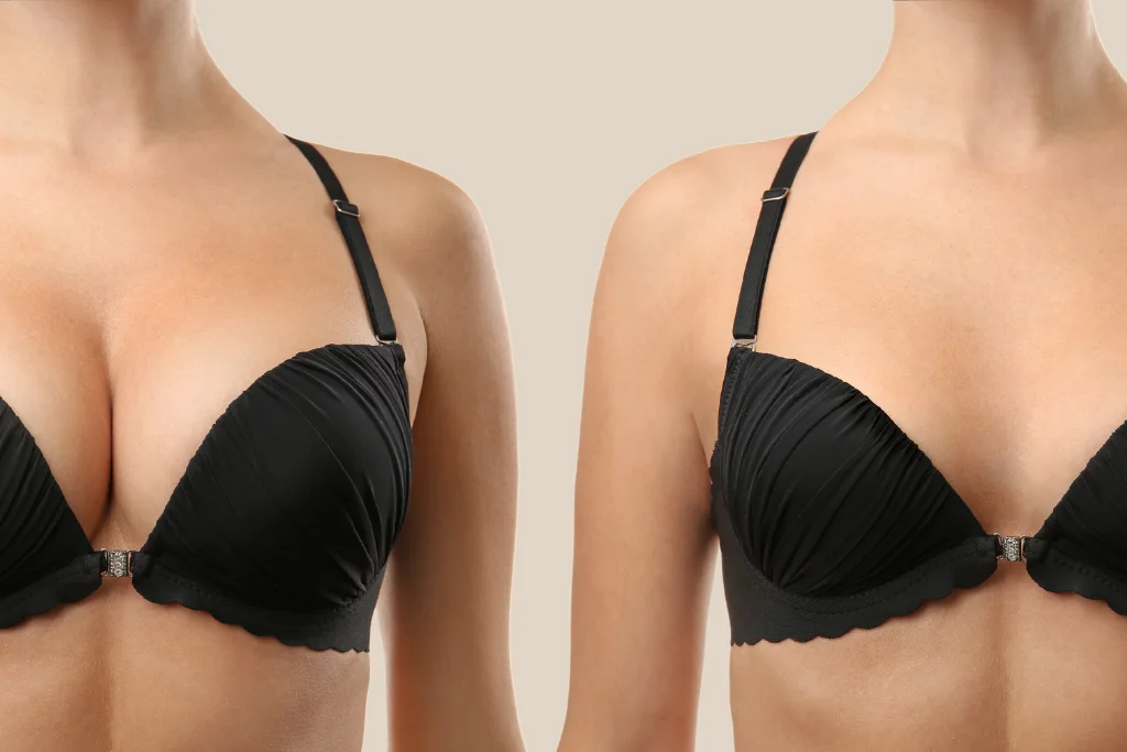 Breast Reduction in Turkey