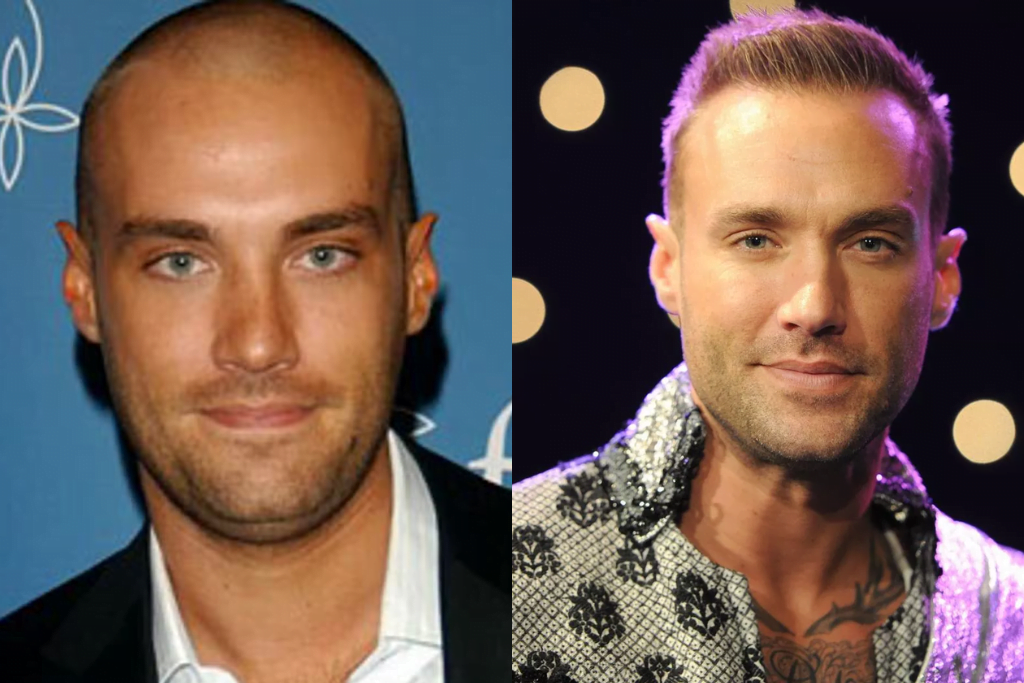 زراعة شعر المشاهير - Calum Best