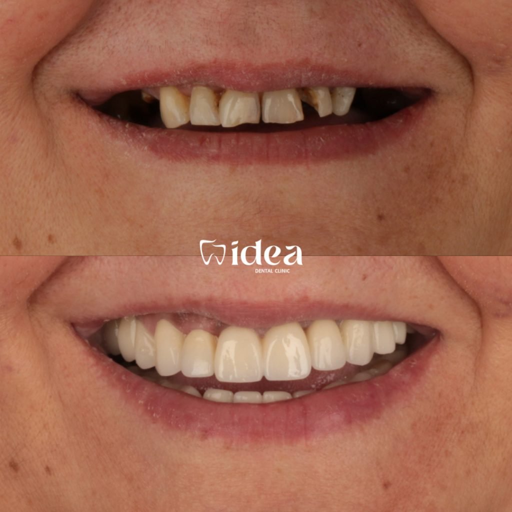 dental-crown-before-after-istanbul