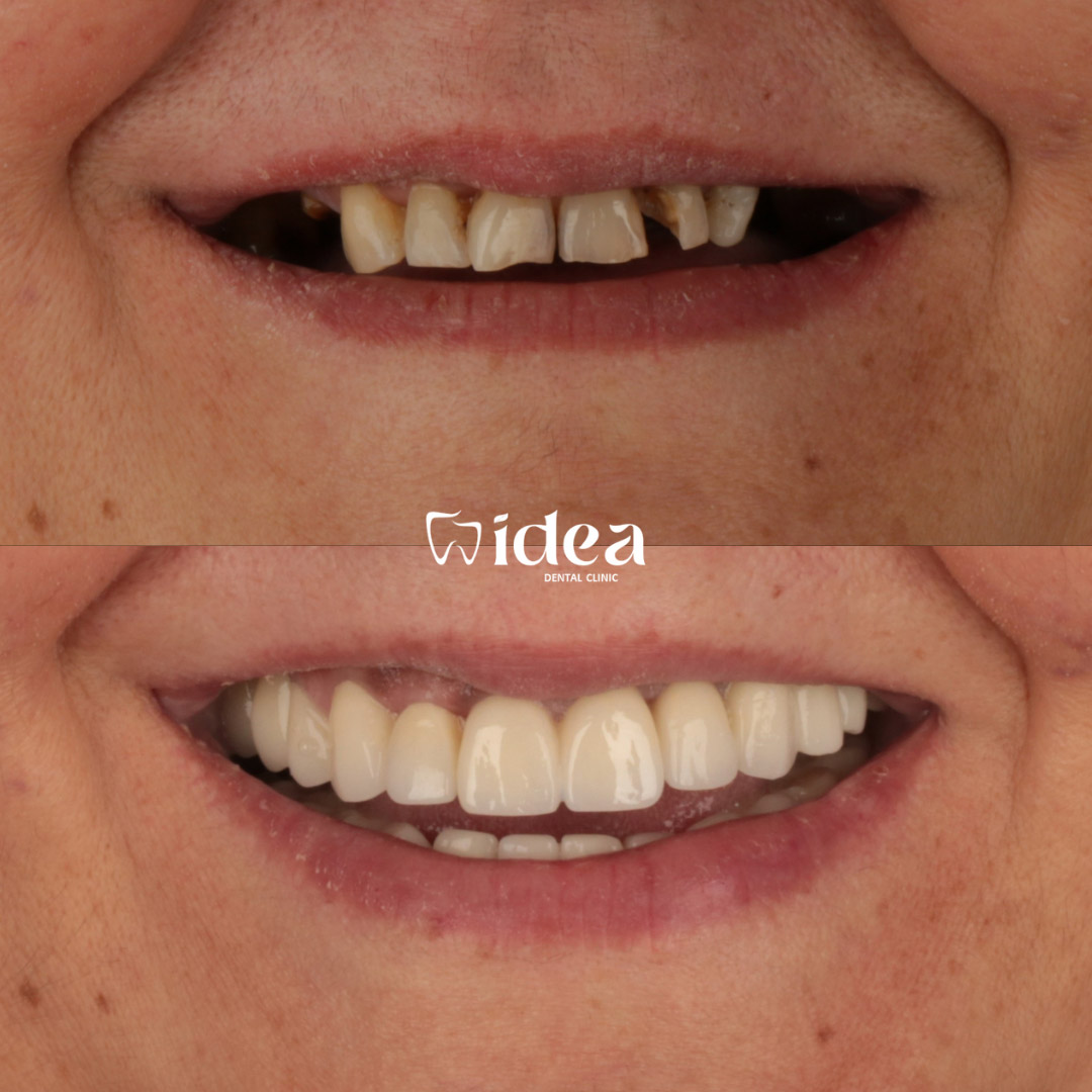 corona dental-antes-despues-istanbul