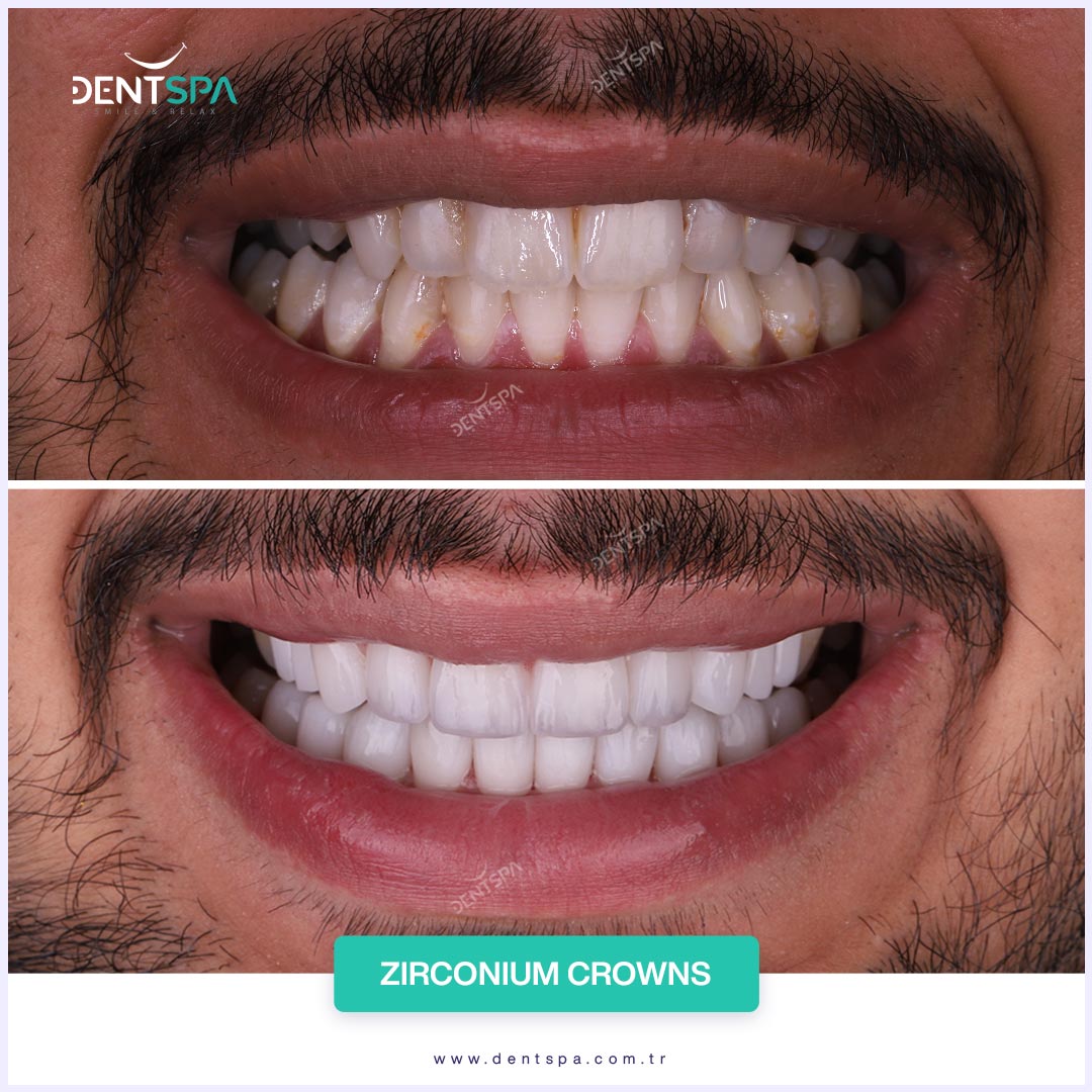 dental-crown-istanbul-before-after