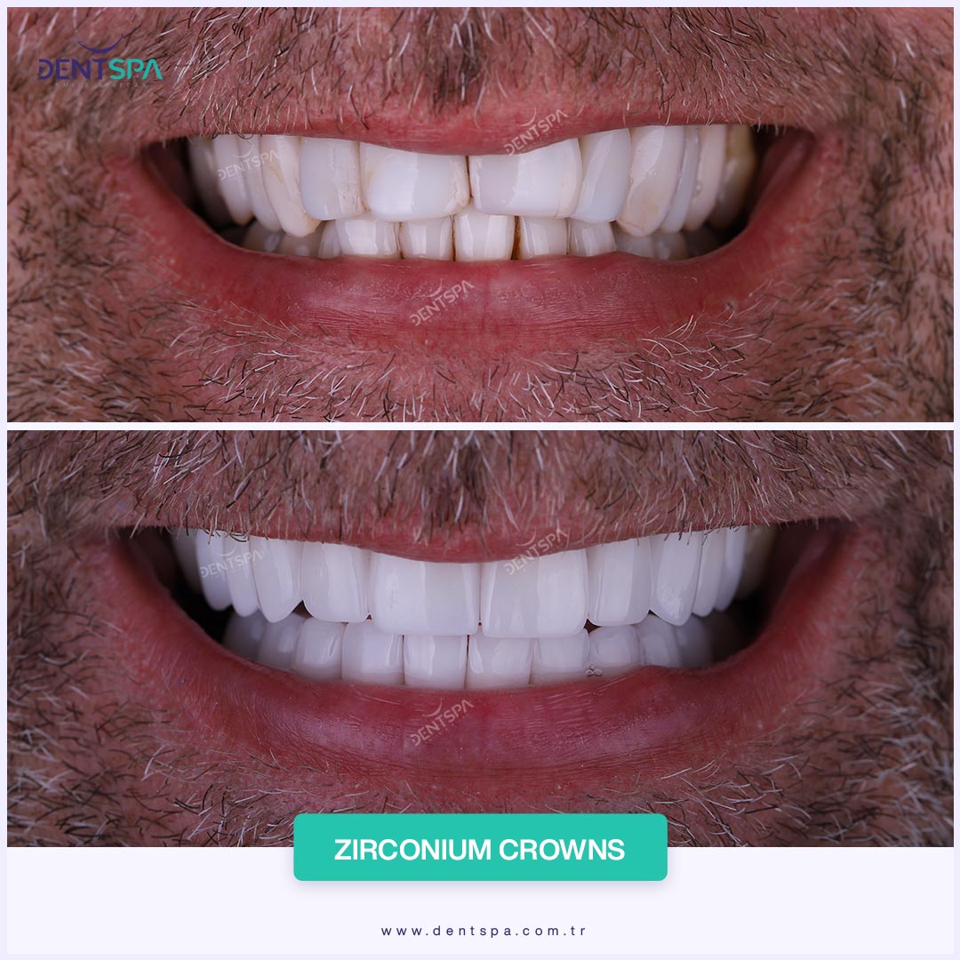 corona dental-istanbul-resultados