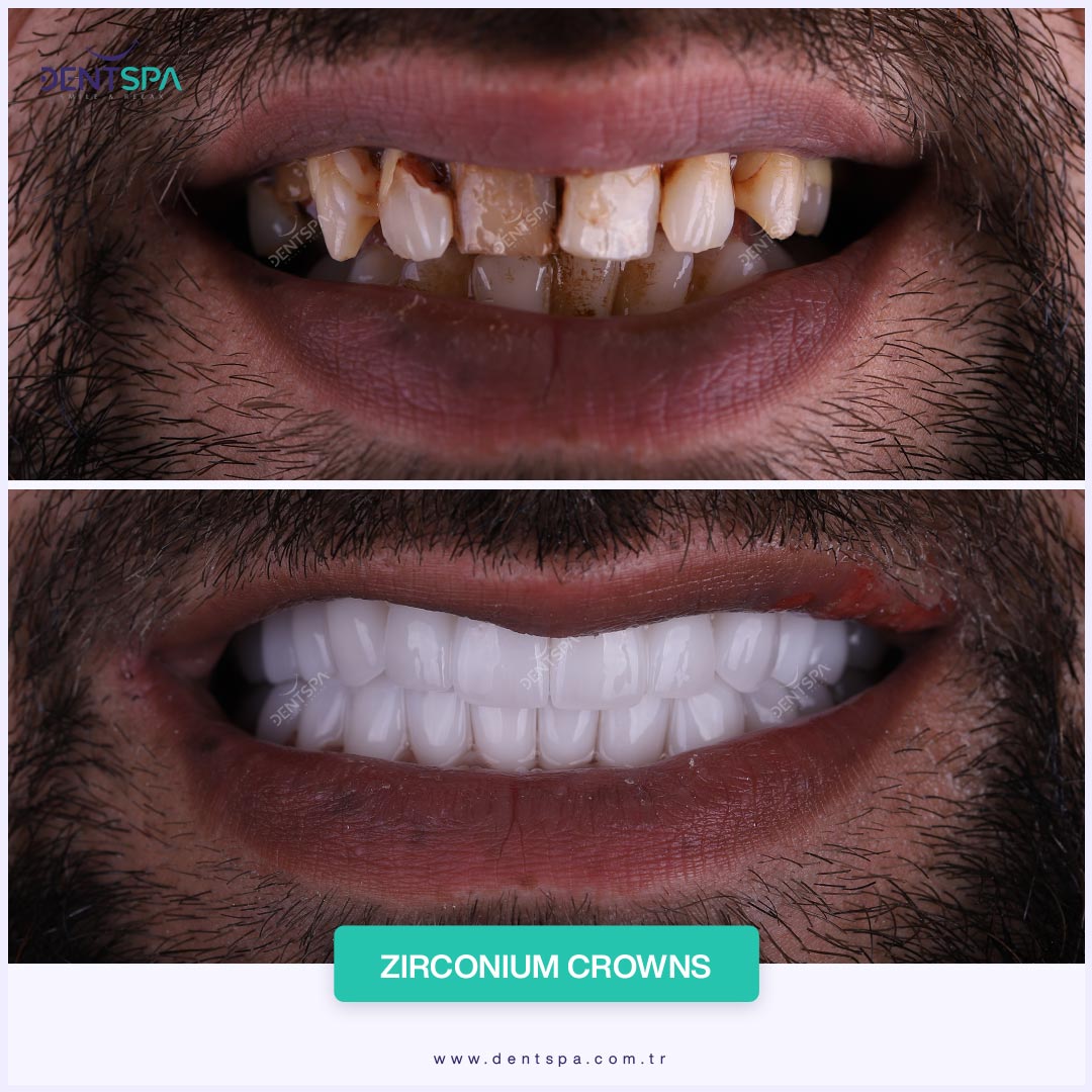 resultados de coronas dentales en estambul