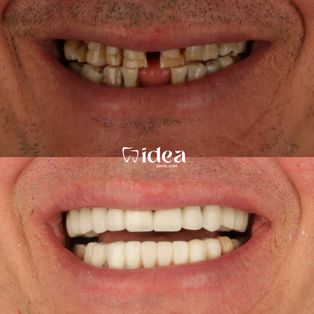 Résultats des couronnes dentaires à Istanbul