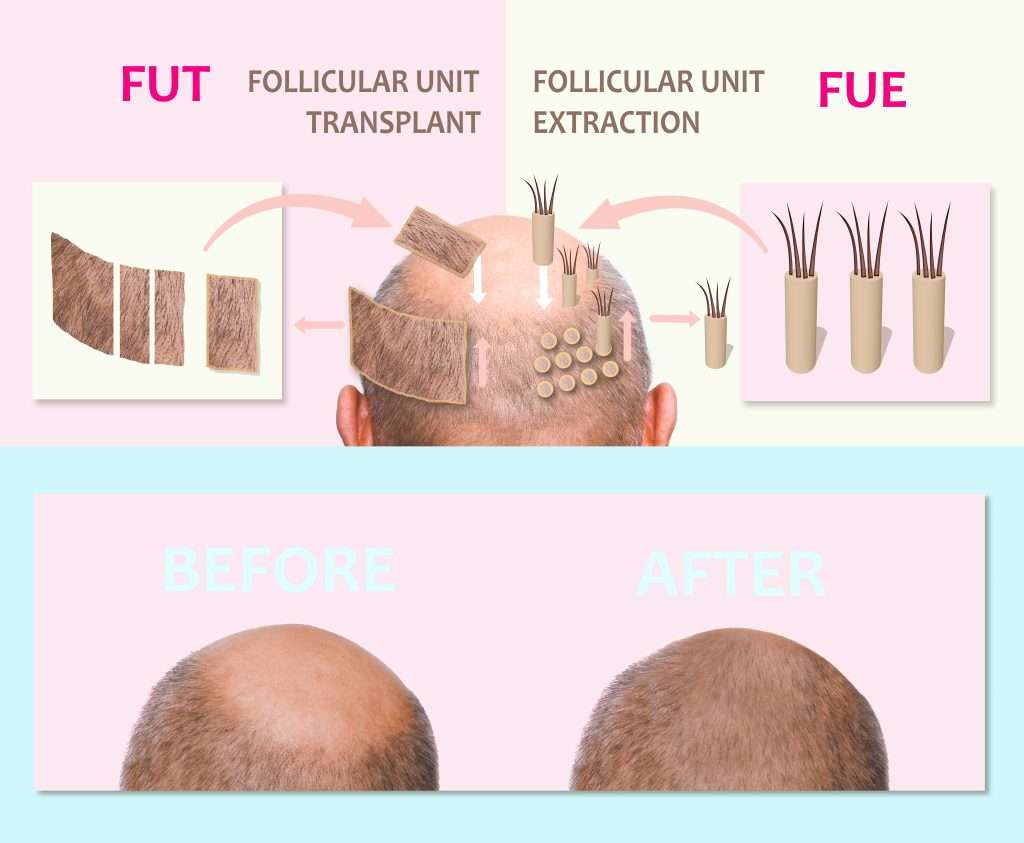 Трансплантация волос FUT и трансплантация волос FUE