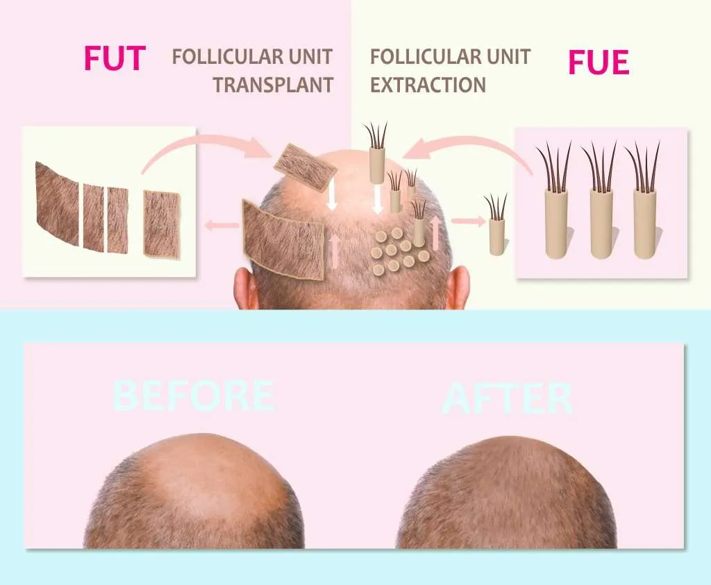 FUT Hair Transplantation and FUE Hair Transplantation