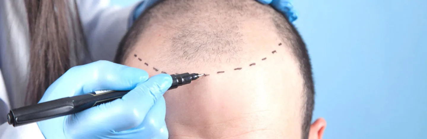 FUE sapphire haartransplantation in istanbul