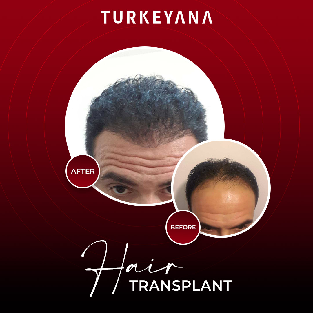 трансплантация волос - стамбул
