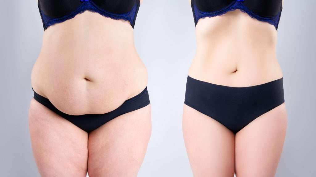 Abdominoplastia en Turquía 2