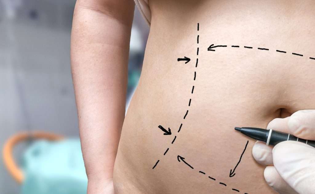 L'abdominoplastie en Turquie