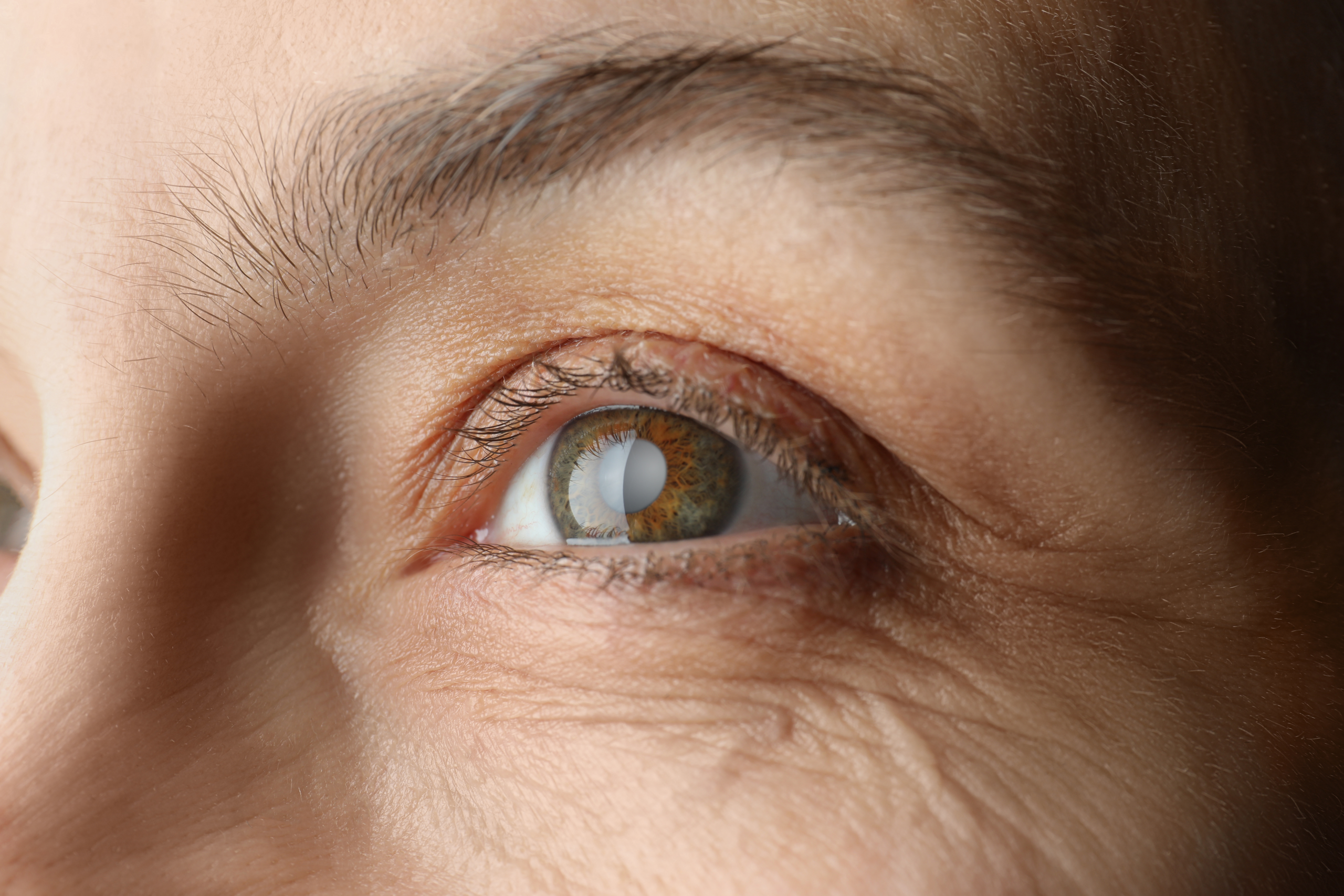 Cataracts Surgery in Istanbul Turkey
