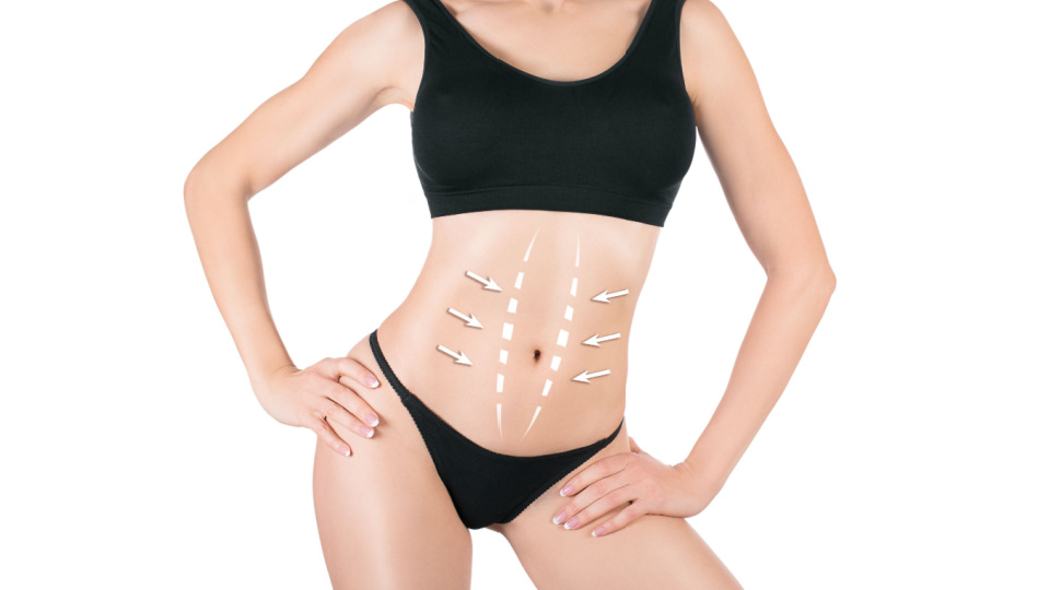 Brazilian Tummy Tuck 2024