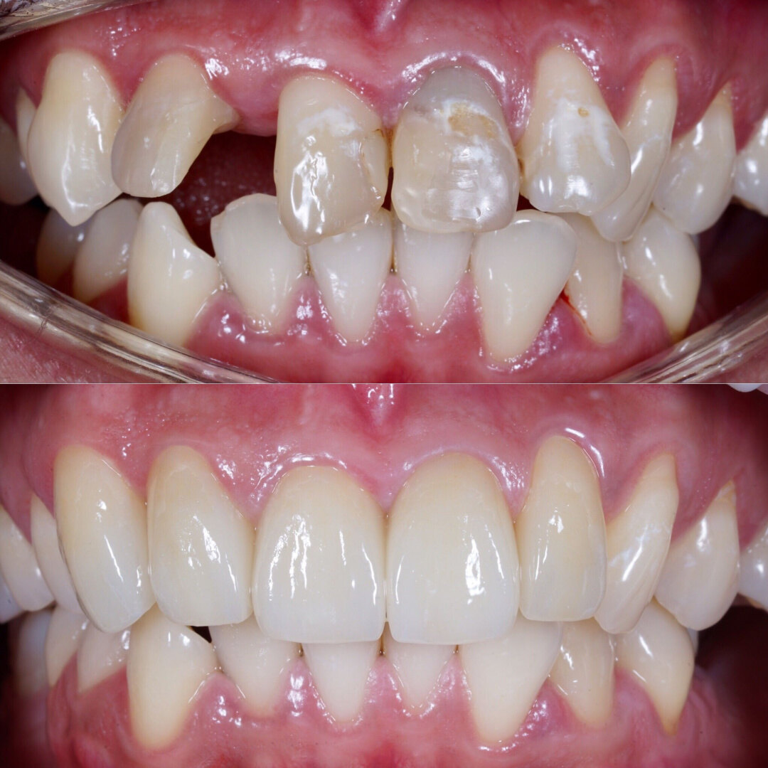 Зубная коронка до и после