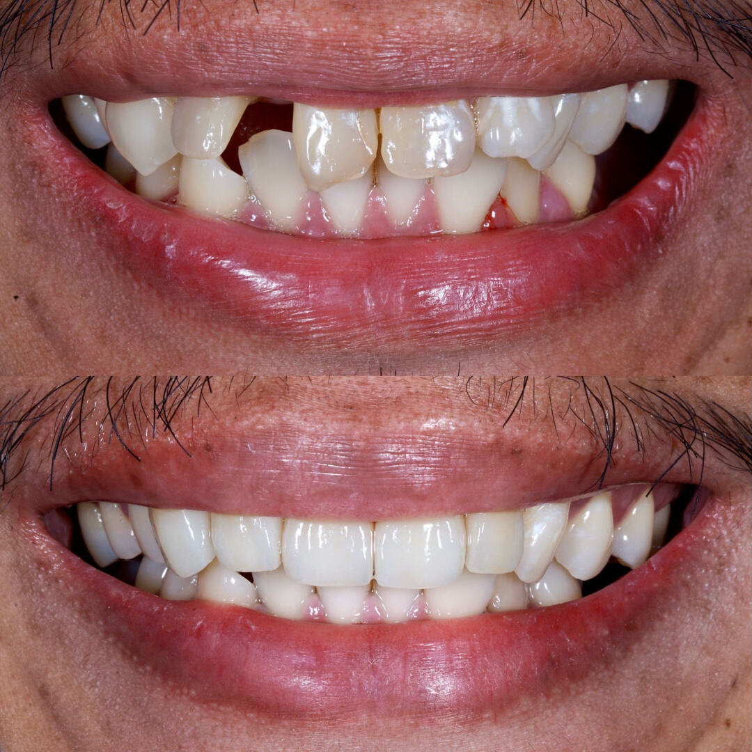 Зубная коронка до и после 2