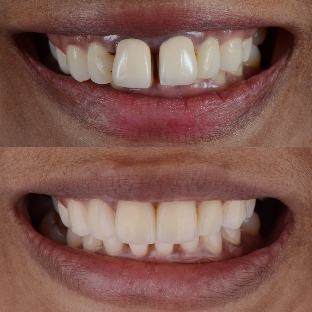 Зубная коронка до и после 3