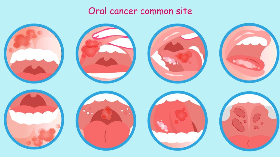 أعراض سرطان الفم