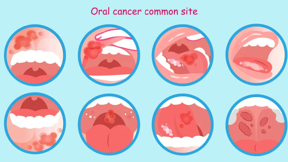 Symptômes du cancer de la bouche