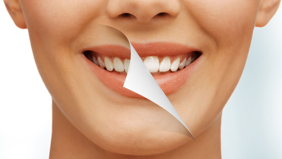 Teeth Whitening for Sensitive Teeth