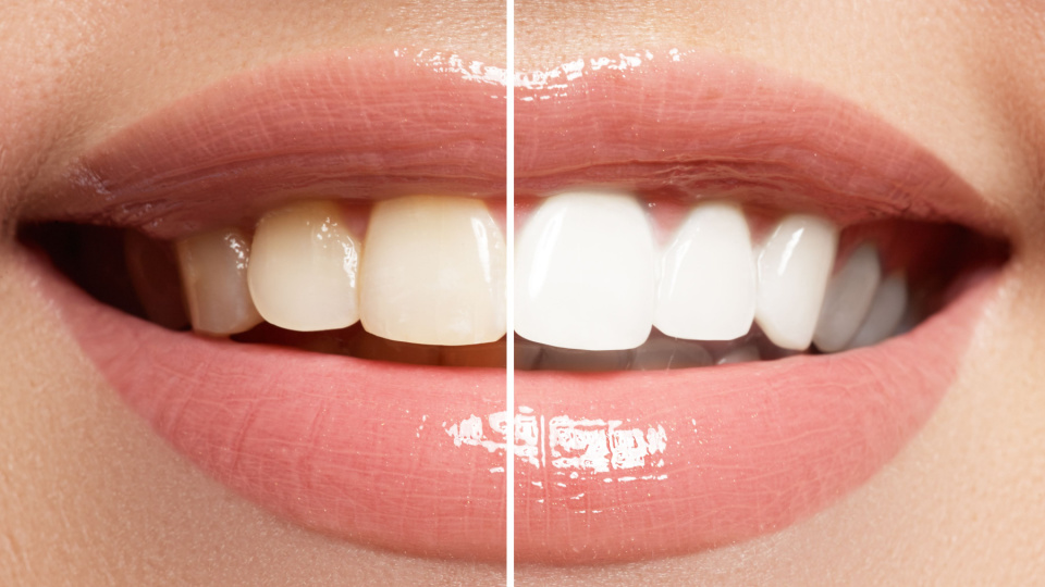 Teeth Whitening Near Me