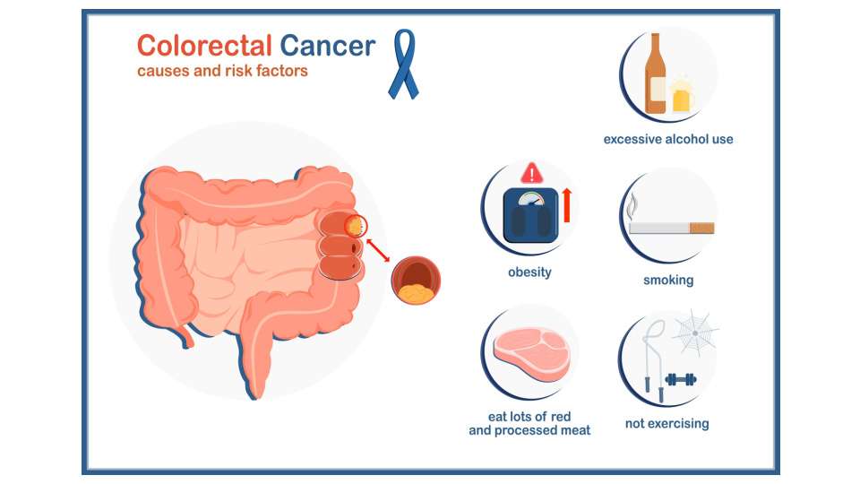 Causas y factores de riesgo del cáncer de colon 