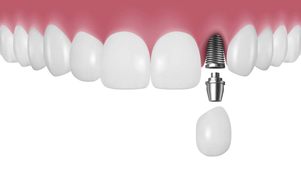 One-stage Implants in Istanbul Turkey