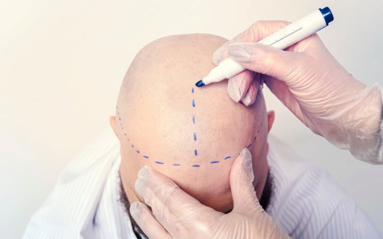 زراعة الشعر بالاقتطاف في أمستردام