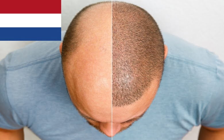 top hair transplant clinics in the netherlands