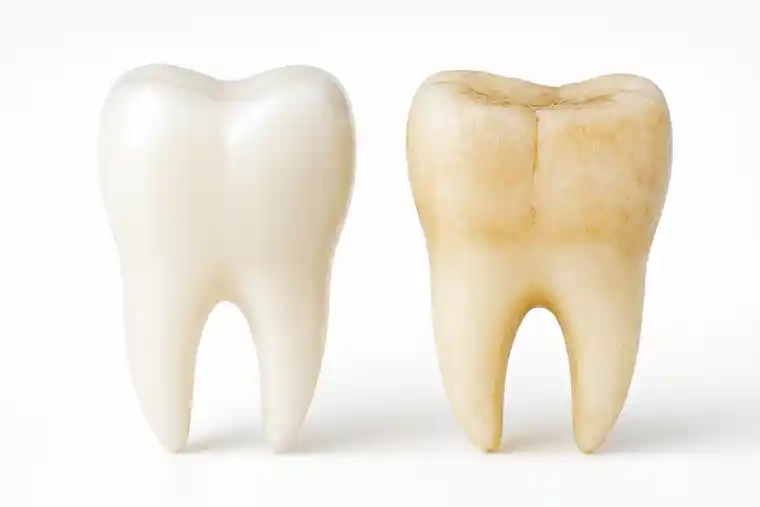 Diagnosing Bruxism - Smile Restored in Istanbul, Turkey