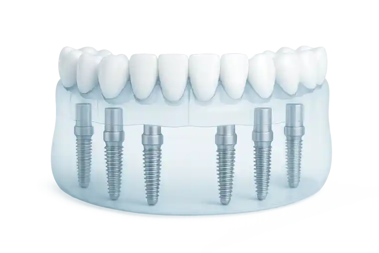 All-on-six Dental Implants in Istanbul, Turkey – Procedure, Benefits & Complete Guide
