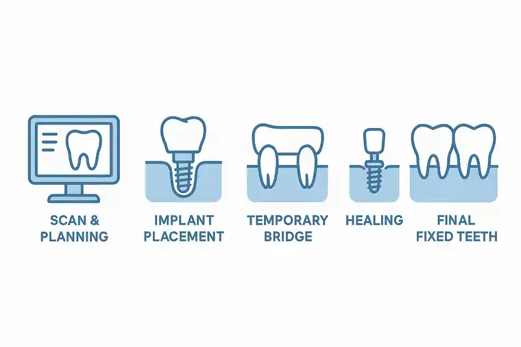 Full Mouth Dental Implants in Istanbul How the Procedure Works Step-by-Step