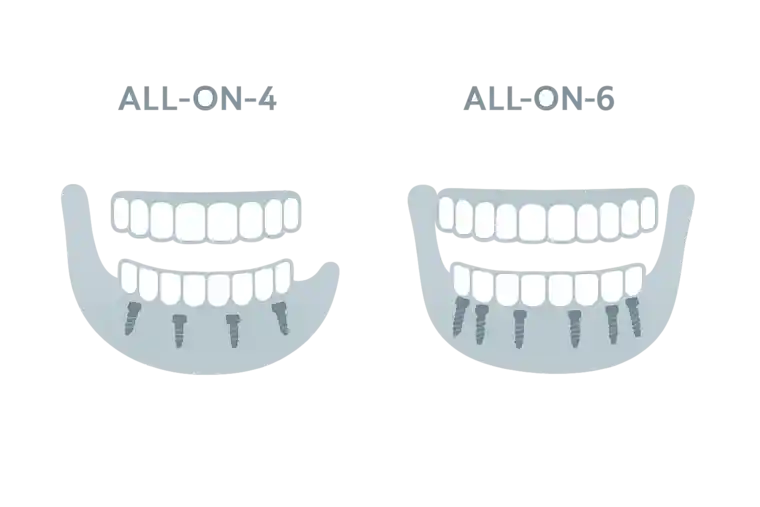 Full Mouth Dental Implants in Istanbul, Turkey All-on-4 All-on-6