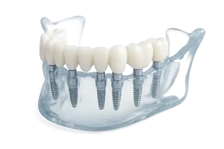 Full Mouth Dental Implants in Istanbul in Turkey Complete Guide