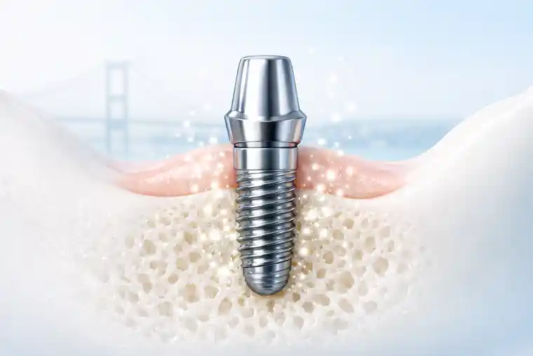 Exosome therapy for dental implants FAQ illustration with subtle Bosphorus Bridge background