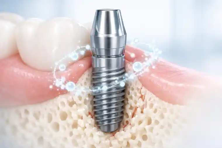 Exosome therapy for dental implants supporting healing around a titanium implant