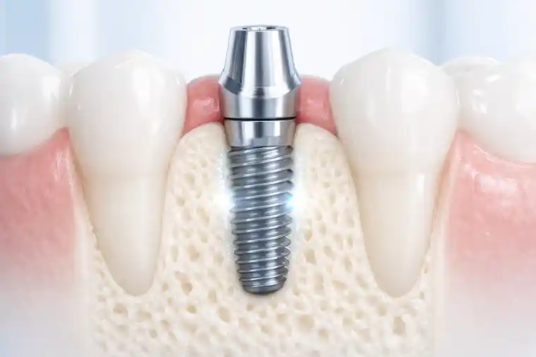 Osseointegration in dental implants showing stable fusion between jawbone and titanium implant