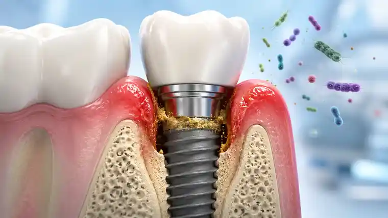 Illustration of bacteria and biofilm around a dental implant showing gum inflammation and early bone loss in peri-implantitis.