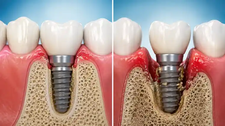 Illustration comparing early and late dental implant failure with implant instability, gum inflammation, and bone loss.